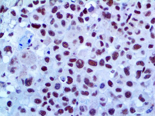 IHC of Fli-1 on an FFPE Angiosarcoma Tissue